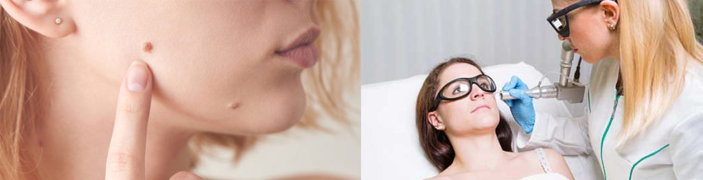 Skin Tag and Mole Removal